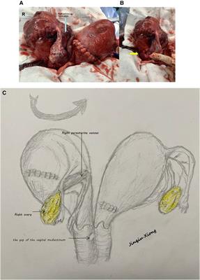 Uterine torsion in twin pregnancy with complete bicorporeal uterus, double cervix, longitudinal non-obstructing vaginal septum - a case report